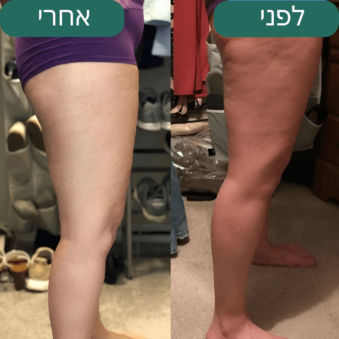 Velutone – מכשיר לעיסוי נגד צלוליט