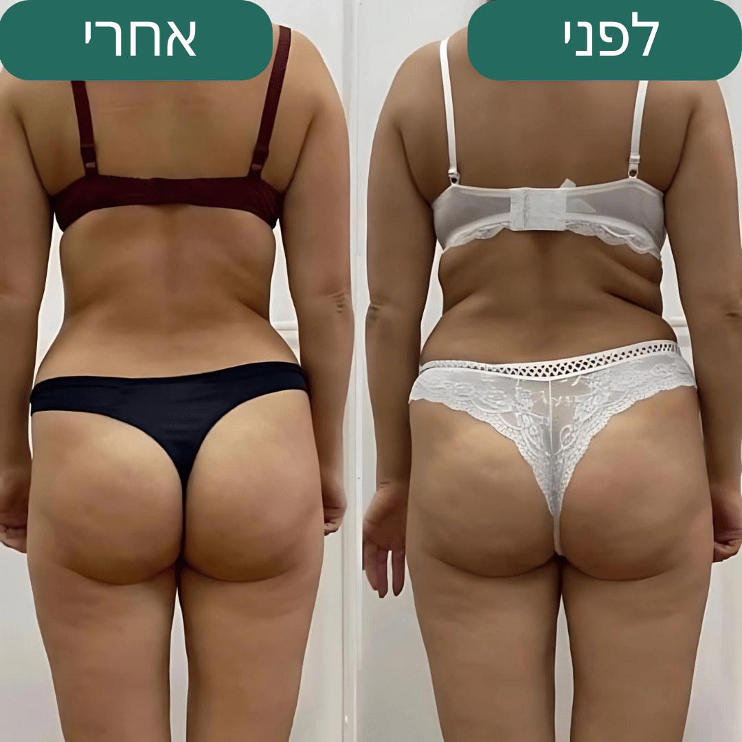 Velutone – מכשיר לעיסוי נגד צלוליט